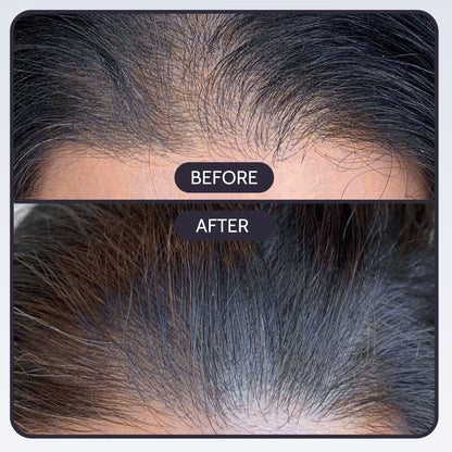 Deepreach™ Hair Restoration System