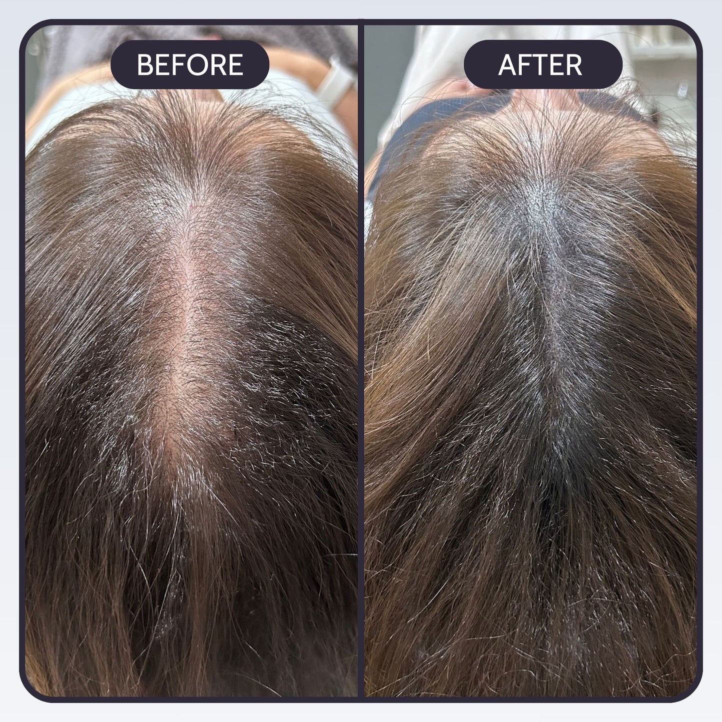 Deepreach™ Hair Restoration System